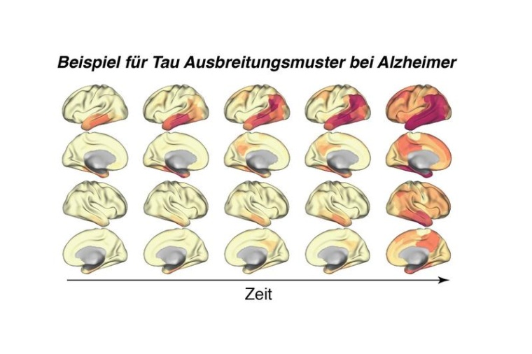 Beispiel für Tau-Ausbreitungsmuster bei Alzheimer. Foto: LMU Klinikum - Dr....