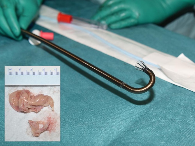 Mit diesem Spezialkatheter wurden die Thromben (kleine Abbildung) abgesaugt....