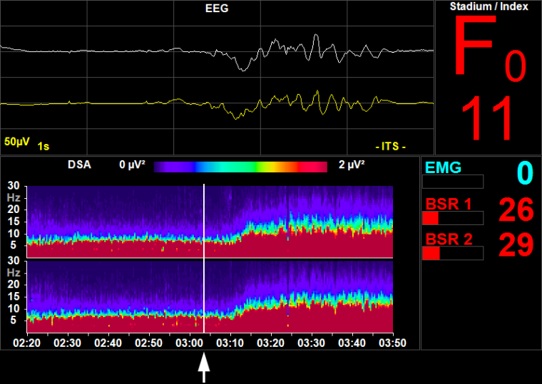 Bildschirm des Narcotrend-Compact M. Original-Signal oben: EEG mit...