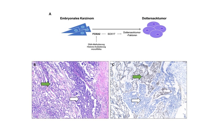Die Bildung von Dottersacktumoren aus embryonalen Karzinomen könnte das...