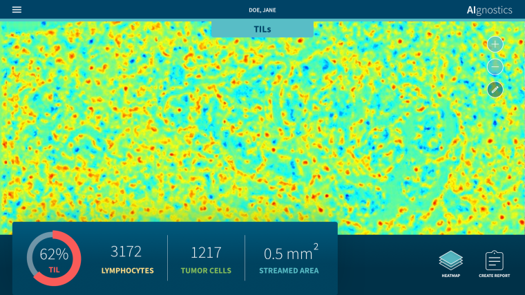 Heatmap zum Gewebepräparat eines Mammakarzinoms. Grafik: Klauschen/Charité