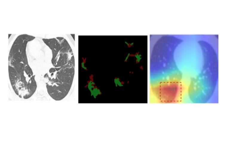Links wird die CT-Lungenausnahme gezeigt, in der Mitte die Milchglastrübung,...