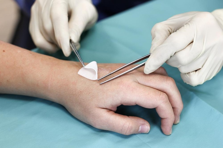 Aufgelegt wie ein Pflaster, kann die aus der Plazentaspende gewonnene...