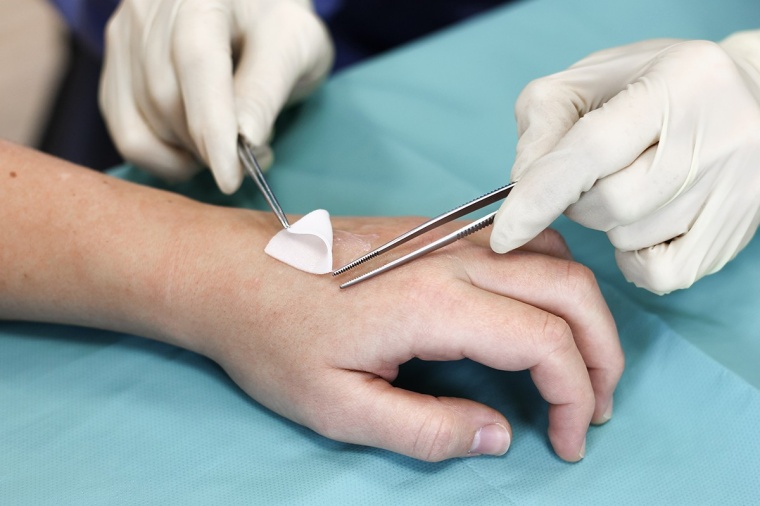 Aufgelegt wie ein Pflaster, kann die aus der Plazentaspende gewonnene...