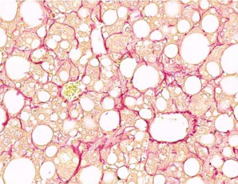 Lebergewebe mit Fibrose und rot markierten Kollagenfasern. Foto: Helmholtz...