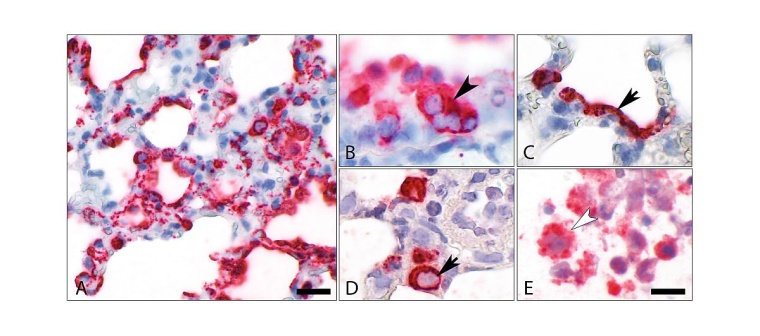 Einblick in infiziertes Lungengewebe: Schon am zweiten Tag befällt SARS-CoV-2,...