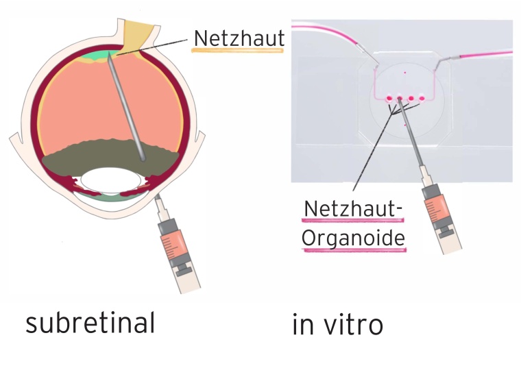 Schematische Darstellung der subretinalen Injektion unter die Netzhaut und in...