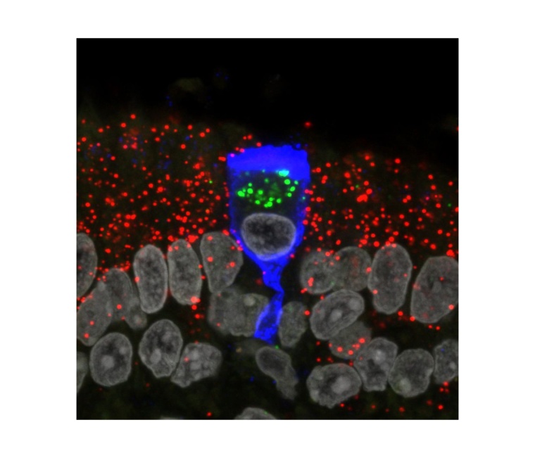 Eine infizierte Stützzelle in der Nasenschleimhaut hat die charakteristische...