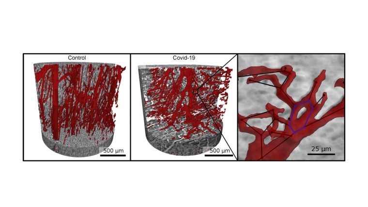 Gefäßnetzwerk (rot) im gesunden Herzgewebe (l.) und bei schwerem Verlauf von...