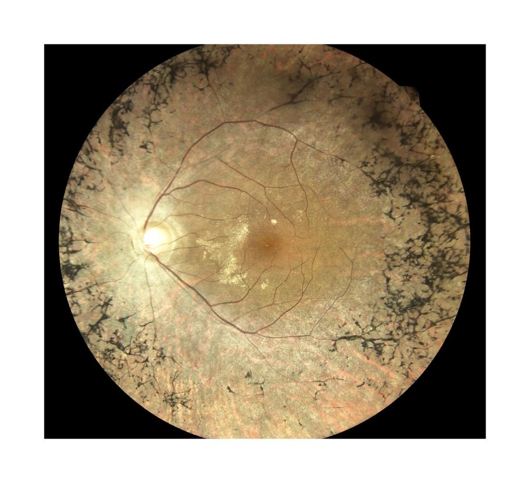 Fotografie des hinteren Augenpols eines Patienten mit Retinitis pigmentosa,...