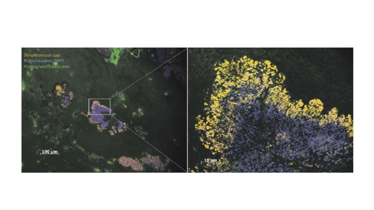 Streptokokken-Biofilm auf einer menschlichen Herzklappe. Links...