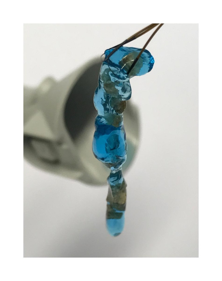 Das Hydrogel mit eingeschlossenen Nierensteintrümmern nach der Entfernung aus...