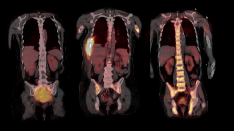 Zusätzlich zu den üblichen Knochenmarkproben aus dem Becken wurden für die...