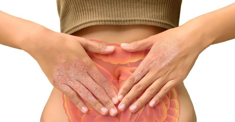 Darmerkrankungen erhöhen das Risiko für Schuppenflechte, das zeigt eine neue...