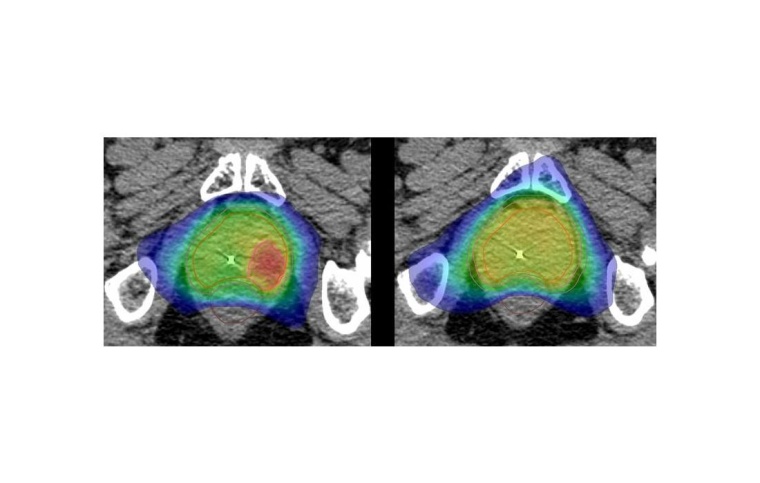 In der Hypofocal-Studie wird genau der Bereich der Prostata, in dem der Tumor...