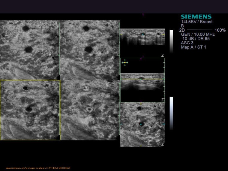 Beispiel für ein Computer-assistiertes Detektions- und Diagnoseverfahren,
als...