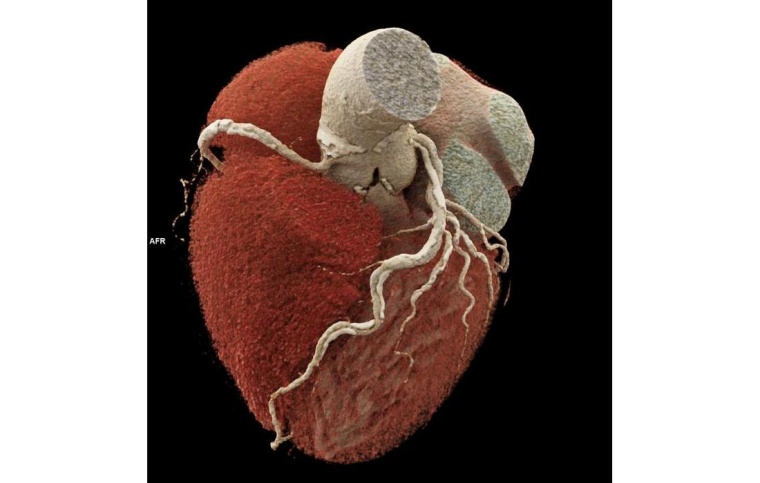 Photon-Counting-CT des Herzens. Trotz sehr schwerer Verkalkungen an den...