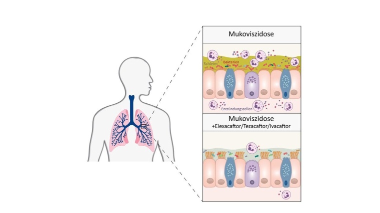 Die Dreifachtherapie mit den Wirkstoffen Elexacaftor, Tezacaftor und Ivacaftor...