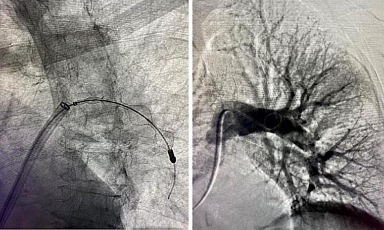 Mit einem neuen System lassen sich Blutgerinnsel in der Lunge per Katheter...