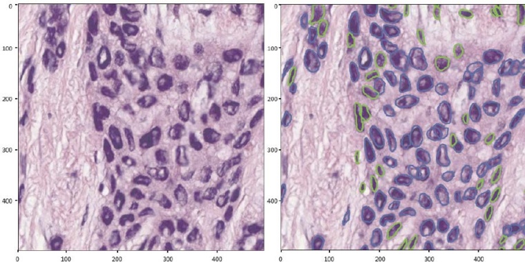 KI-Unterstütze Analyse von Zellkernveränderungen in der modernen...