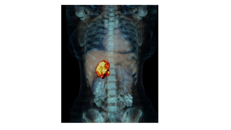 Das Nebennierenkarzinom ist eine bösartige Entartung einer der Hormondrüsen,...
