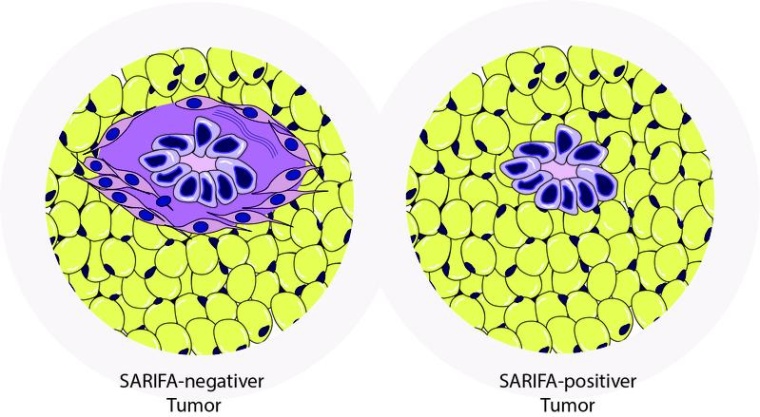 Bei SARIFA-negativen Tumoren (l.) werden die Krebszellen (blau) durch...