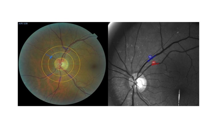Bei einer Augenuntersuchung können der Durchmesser kleinster Blutgefäße (l.)...