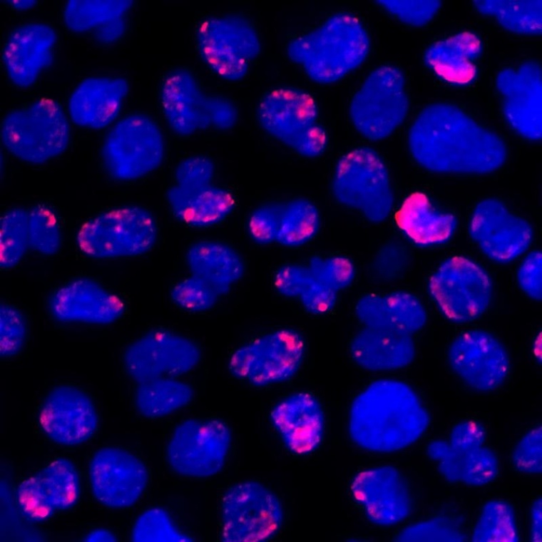 R-Loops (pinke Färbung) häufen sich an AML-Zellen an. Werden sie nicht...