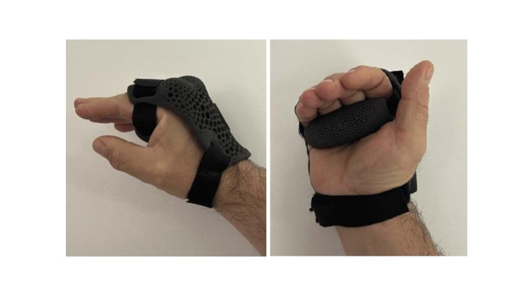 Handorthese mit Klettband (l.) und palmarer Druckleiste (r.)