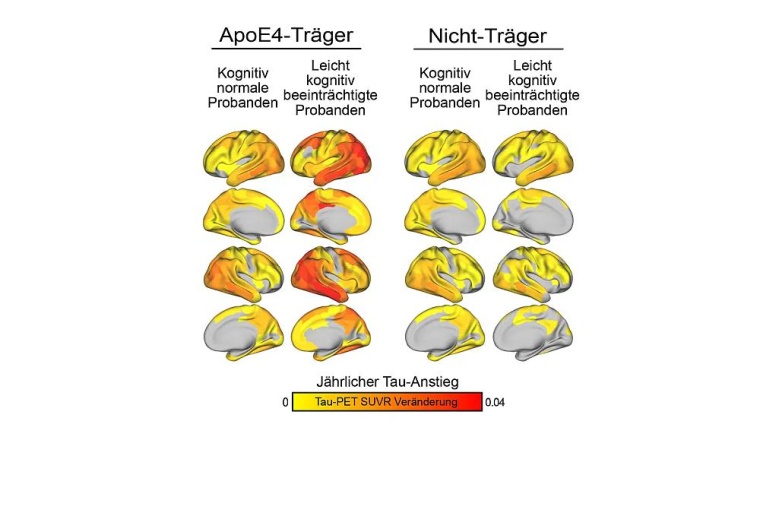 Ein Studienergebnis: ApoE4-Träger zeigen eine stärkere Amyloid-abhängige...