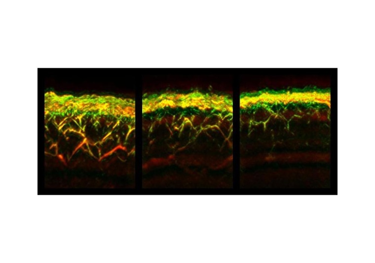 RSOM-Aufnahmen von Haut eines gesunden Probanden (links), eines Patienten mit...