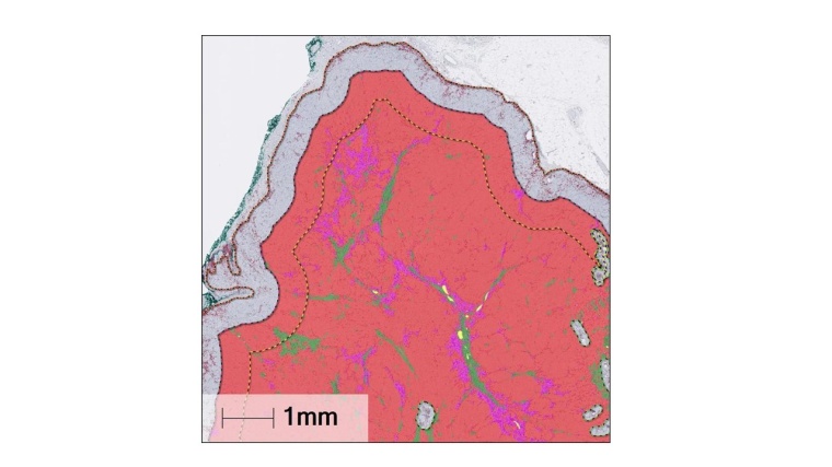 KI-basierte Segmentierung von Melanommetastasen in einem Tumor. Foto: USZ