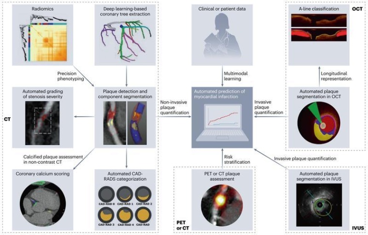 KI-gestützte Anwendungen zur Plaque-Diagnose und Prognose in der koronaren...