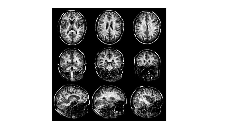 Mit besseren MRT-Scans der Myelinscheiden im Gehirn soll Multiple Sklerose...