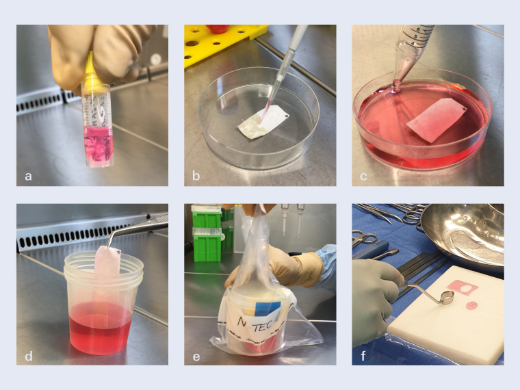 Collage zur Vorbereitung des Knorpelimplantats N-TEC: a) der Nasenknorpel wird...