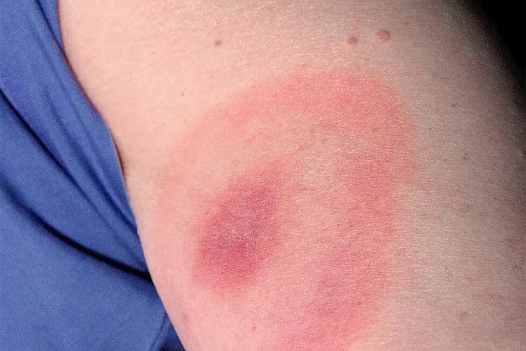 Wanderröte (Erythema migrans) ist ein frühes Symptom einer...