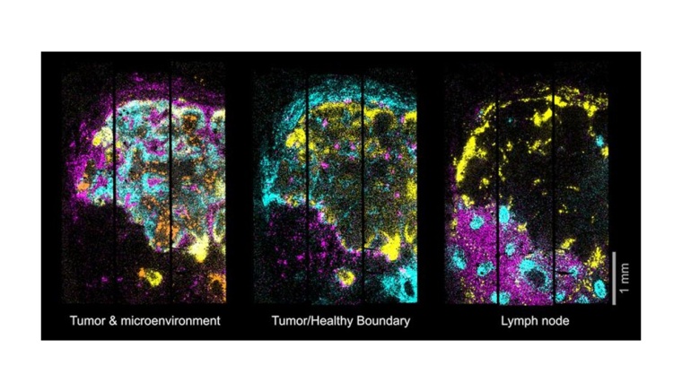 2D-Karte der Genexpression in einem metastasierten Lymphknoten Foto: AG N....