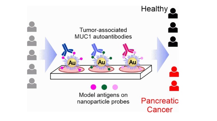Bessere Früherkennung von Bauchspeicheldrüsenkrebs Foto: Wiley-VCH