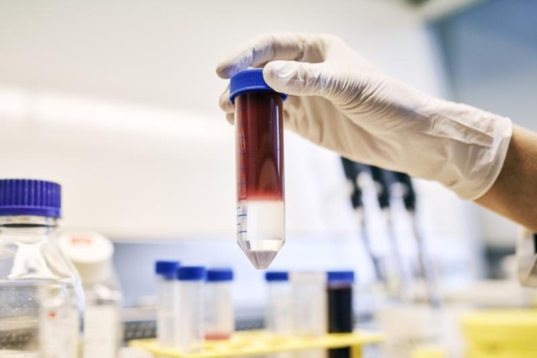 Bei der adoptiven T-Zell-Therapie werden patienteneigene Immunzellen (T-Zellen)...