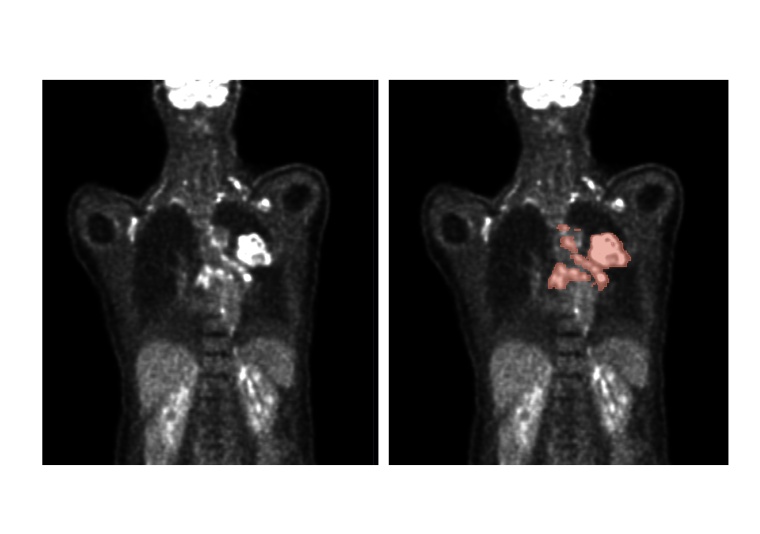 Automatische Verfahren ermöglichen die Analyse von PET/CT-Scans (links) zur...