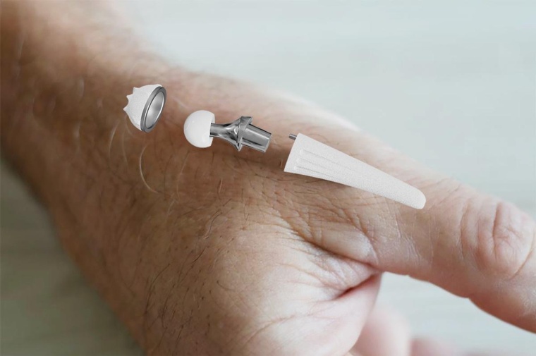 Eine Arthrose des Daumensattelgelenks erfordert in manchen Fällen den Einsatz...