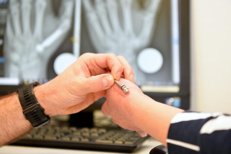 Nur eine kleine Narbe bleibt nach der Implantation der Prothese zurück. Foto:...