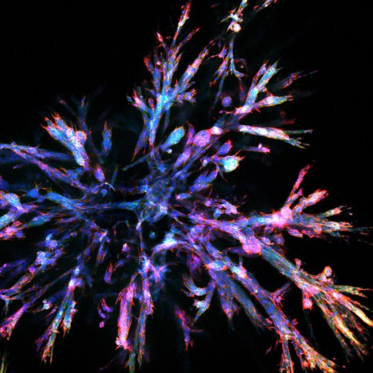 Bauchspeicheldrüsenkrebs-Organoid Foto: Aristeidis Papargyriou, TUM