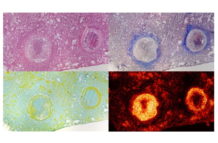 Neuartiges Antibiotikum BTZ-043 erreicht auch Tuberkulosebakterien, die sich in...