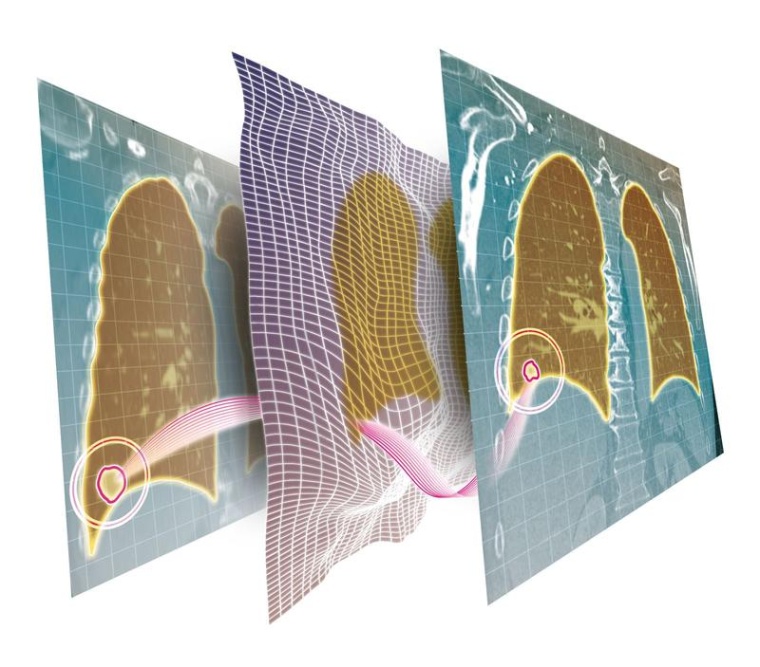 Dank eines Deep-Learning-Ansatzes lassen sich CT-Bilder in der Krebstherapie...