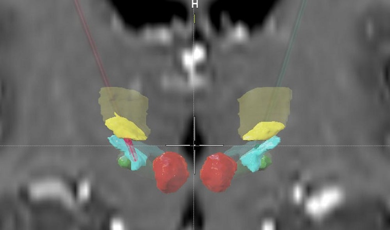 Die Lage der implantierten Elektroden in den Basalganglien des Patienten. Foto:...