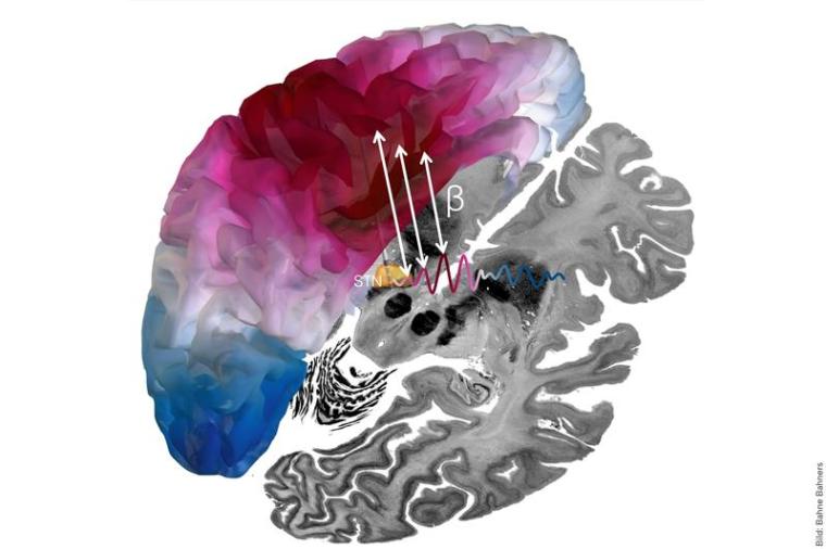 3D Darstellung der Beta-Konnektivität zwischen dem Ort der Stimulation...