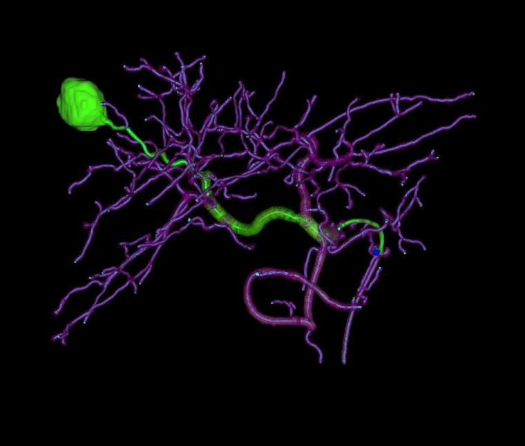 Der KI-gestützte MyEmbolization Guide zeigt klar den Zieltumor und...