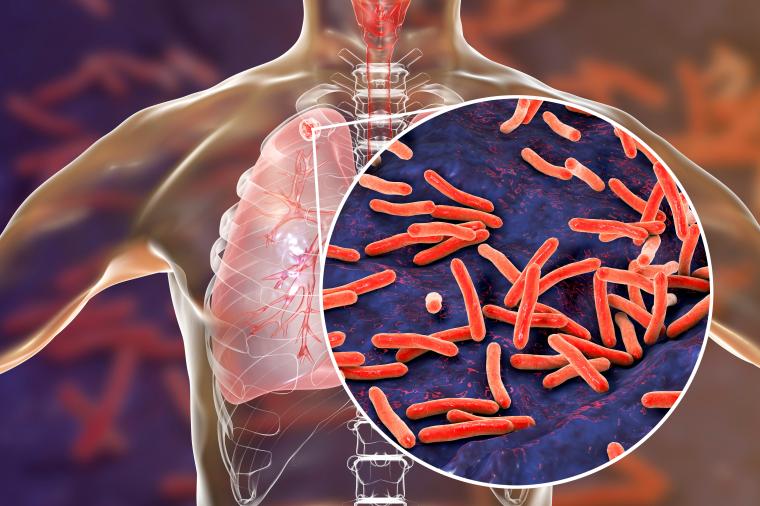Ein Abstrich genügt für einen einfacheren Tuberkulose-Nachweis