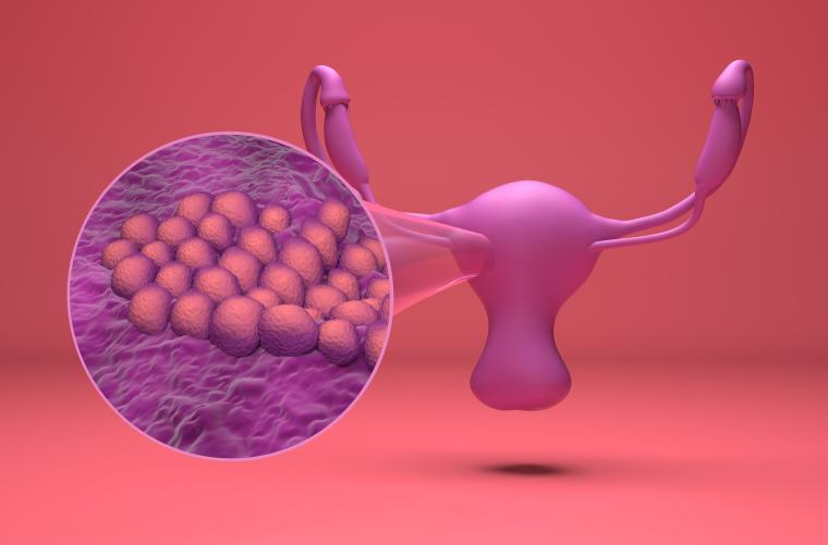 S3-Leitlinie Endometriumkarzinom aktualisiert